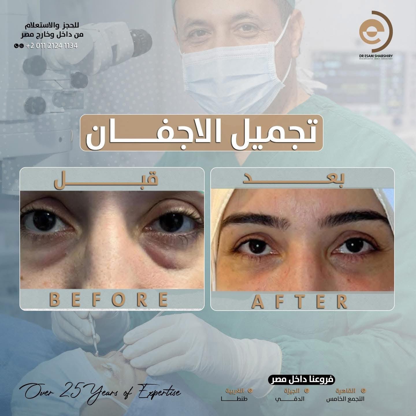 تجميل الجفون