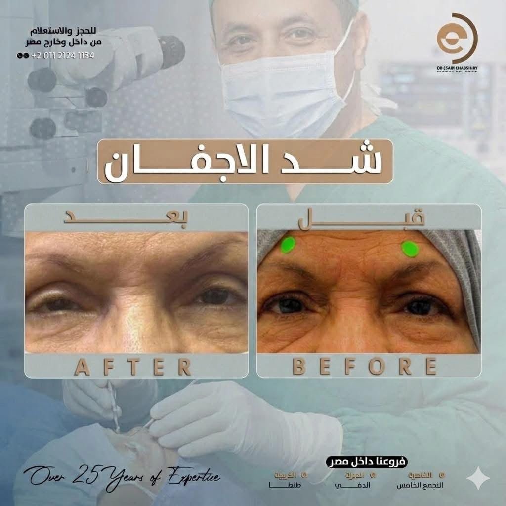 نحت وتجميل الجفون المزدوجة بتناسق طبيعي