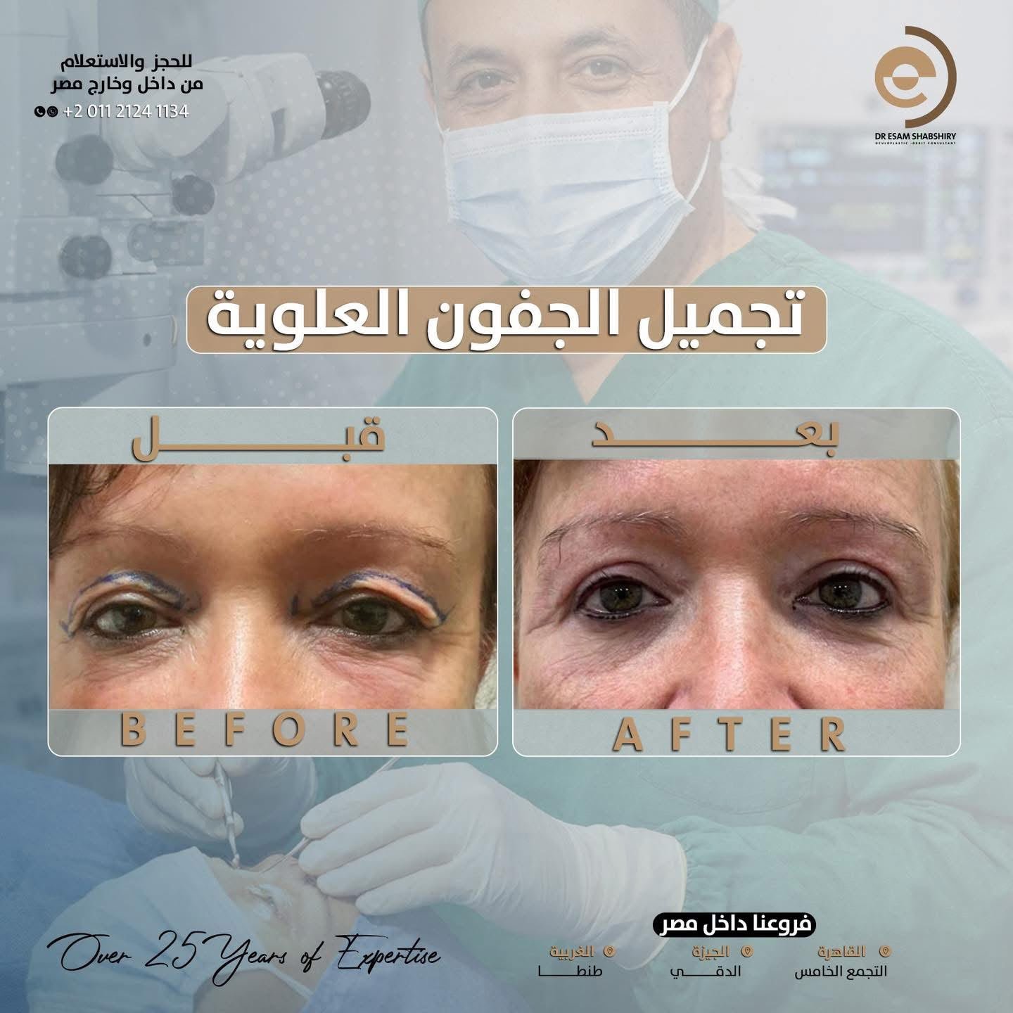 تجميل الجفون العلوية وتوسيع مجال الرؤية