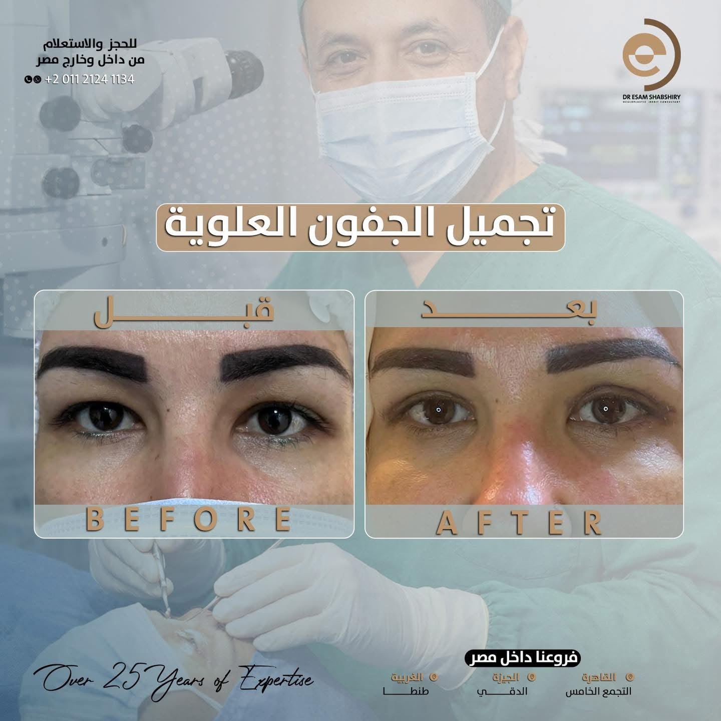 استعادة نضارة محيط العين وامتلاء الجفن الطبيعي