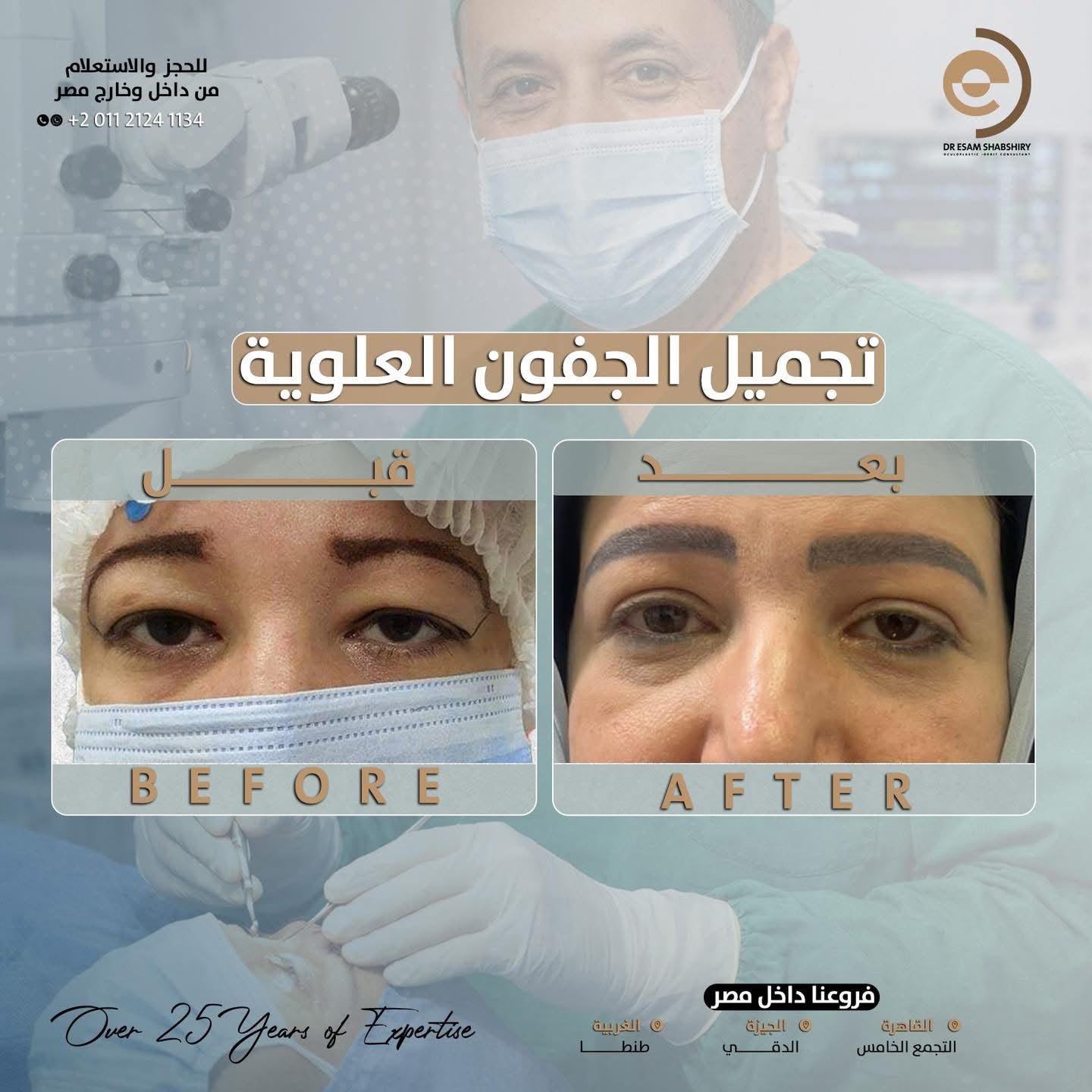 شد ورفع زاوية الجفن الخارجي (Canthopexy)