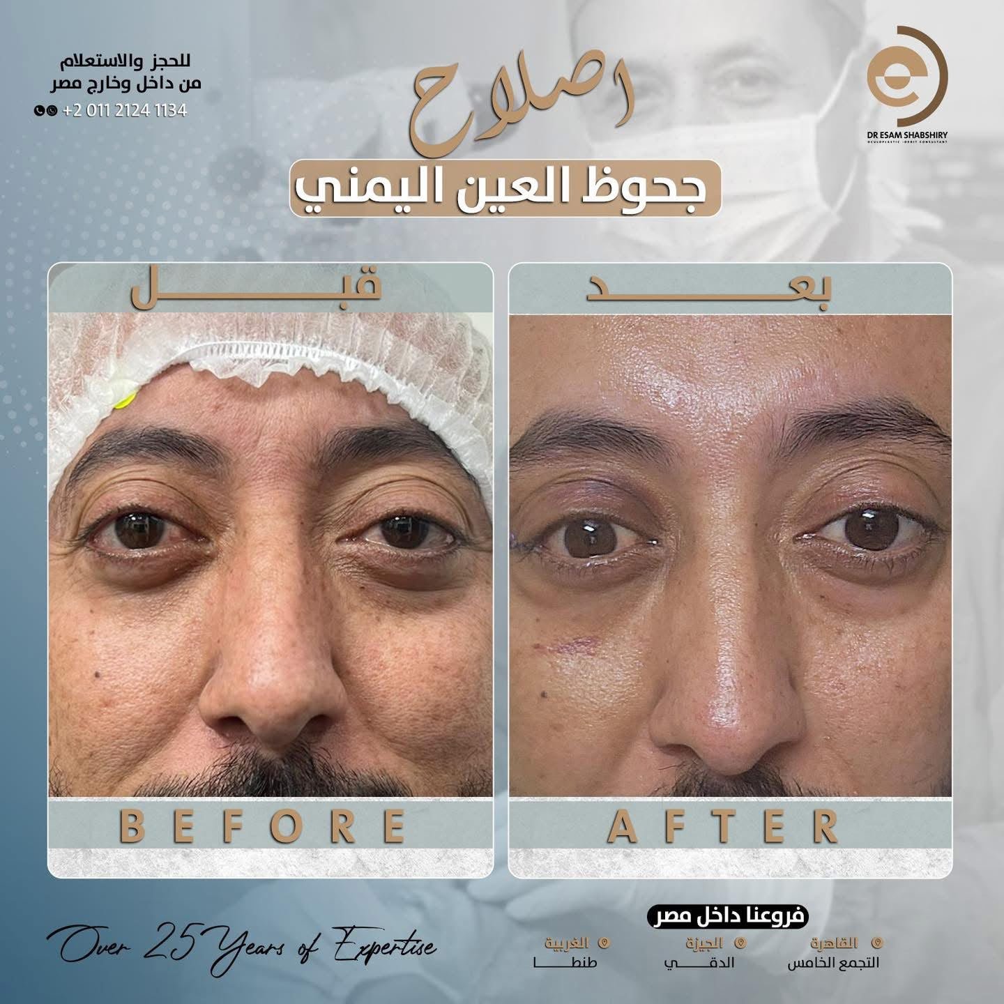 علاج جحوظ العين