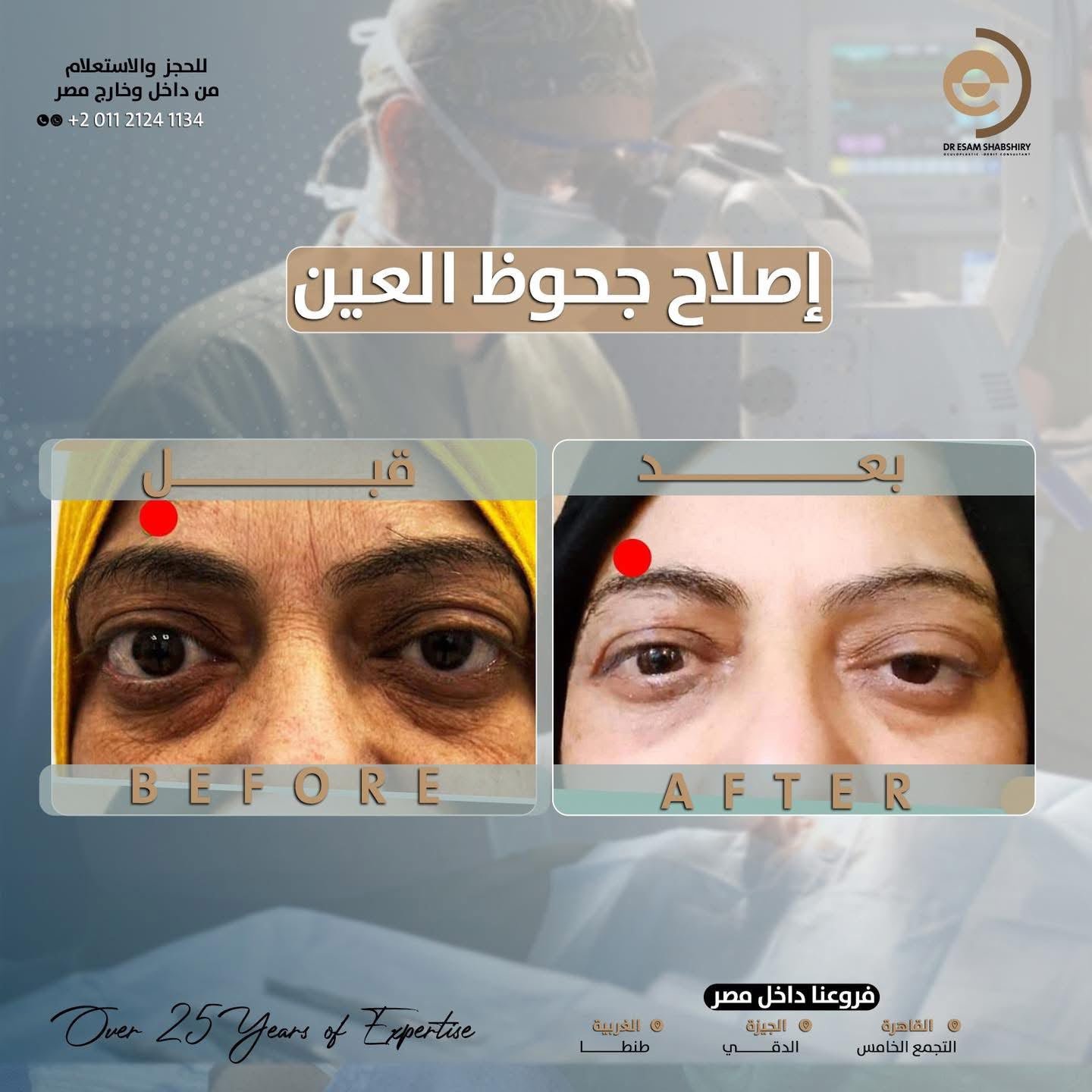 توسيع تجويف محجر العين (Orbital Decompression)