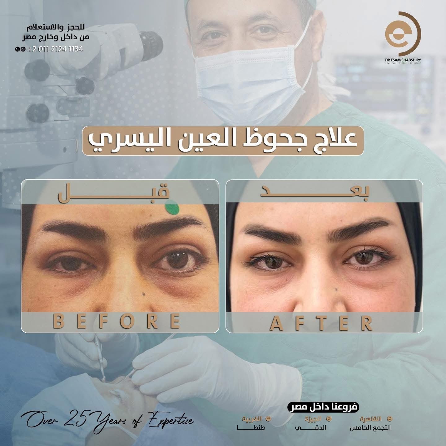 علاج جحوظ العين التناظري وإعادة العين لموضعها