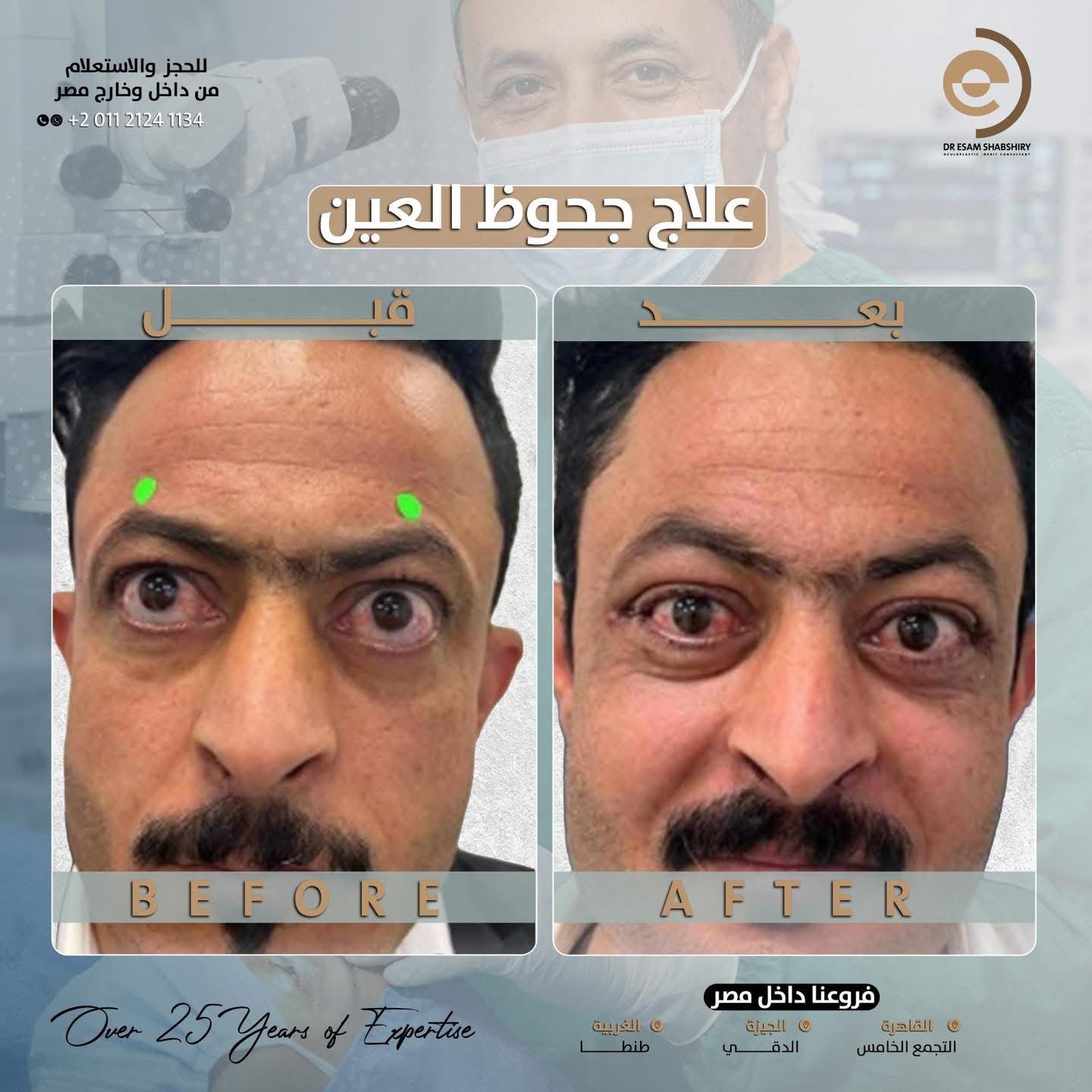 حماية القرنية وإنهاء مشكلة عدم انغلاق الجفون