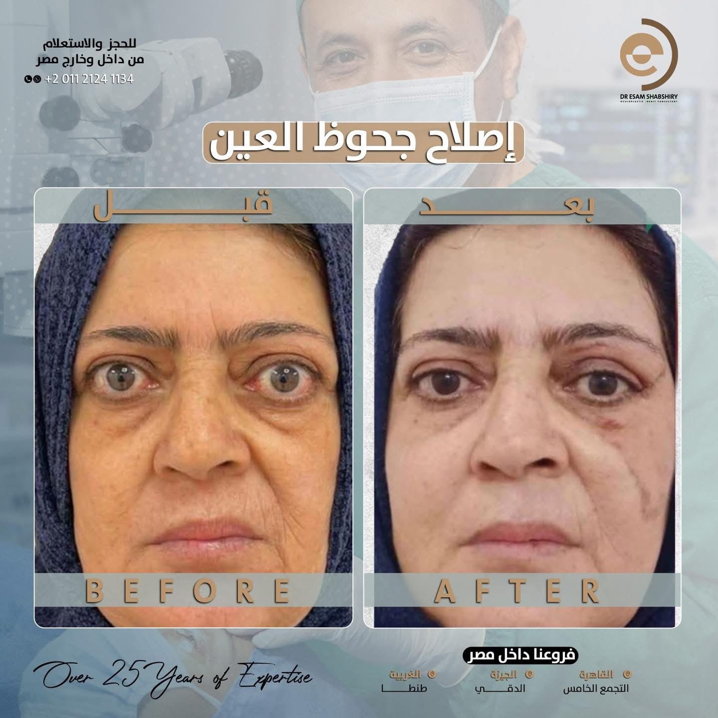 تخفيف ضغط المحجر واستعادة راحة العينين
