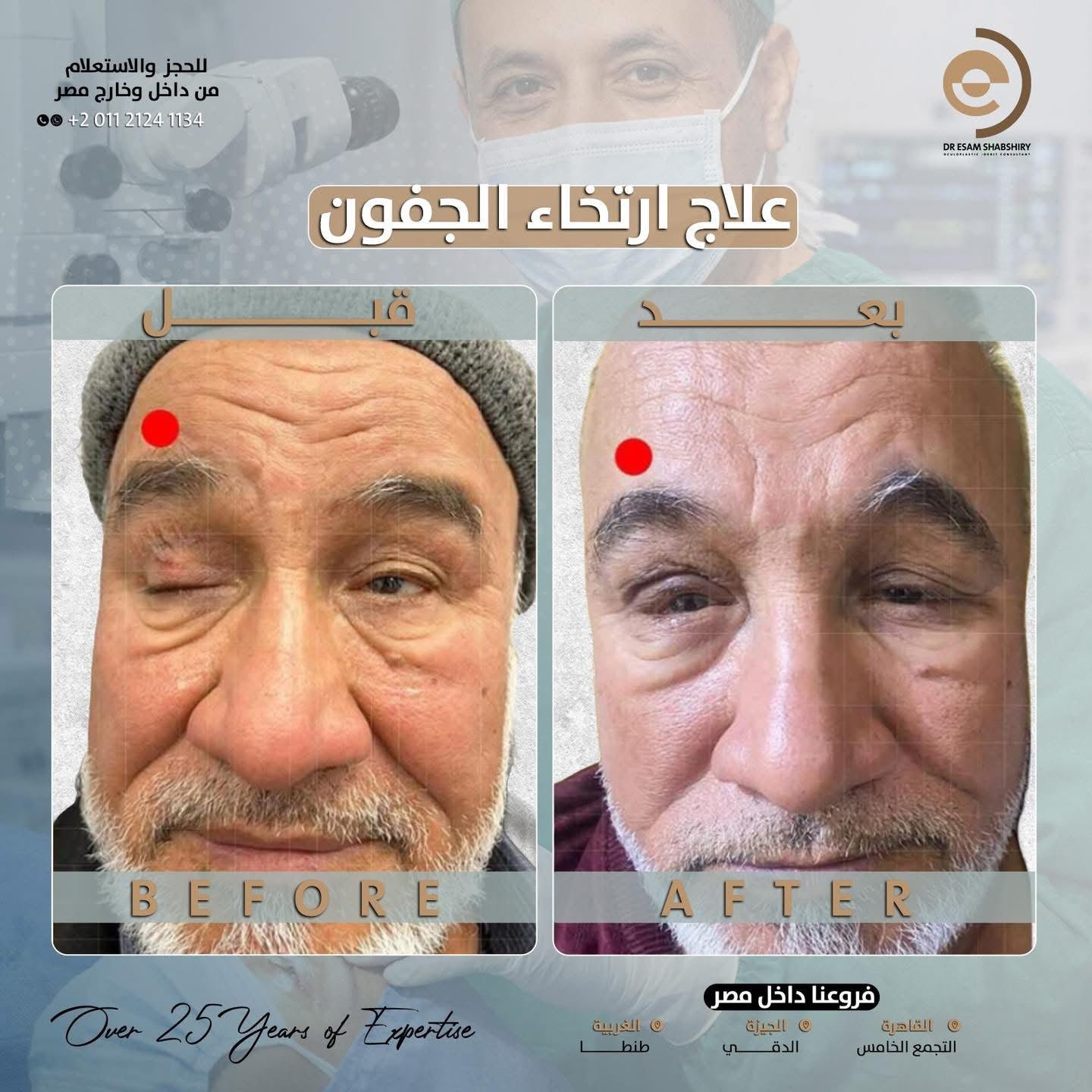 إصلاح ارتخاء الجفون