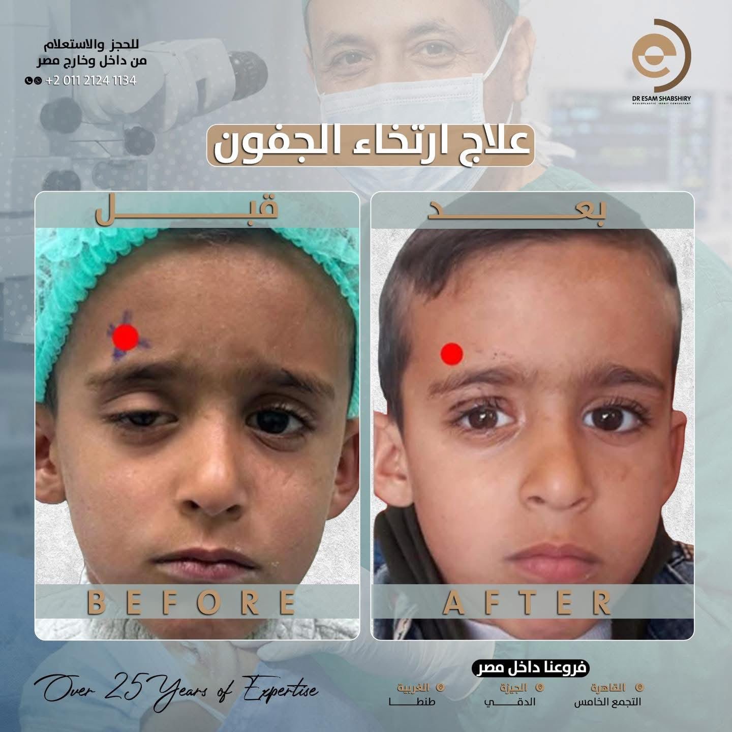 ارتخاء الجفون