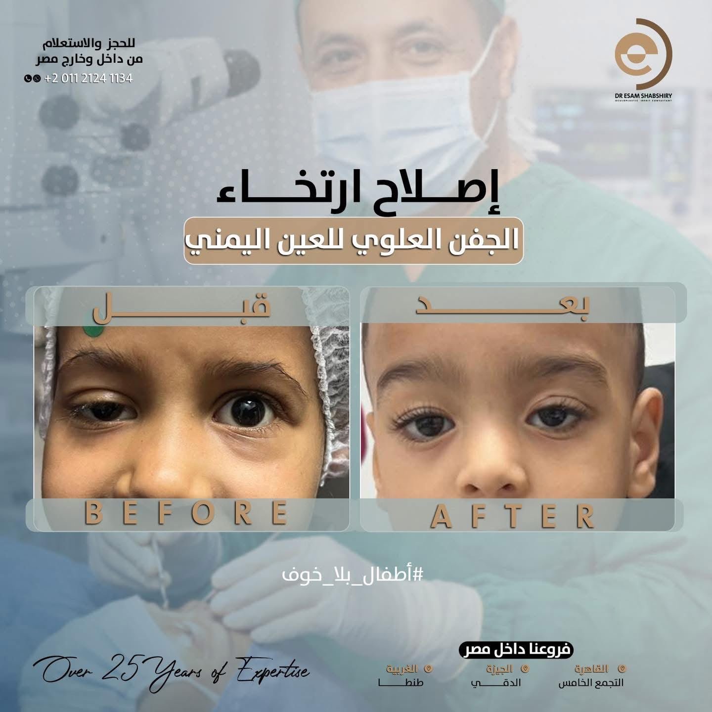 علاج ارتخاء الجفن الولادي واستعادة تماثل العينين