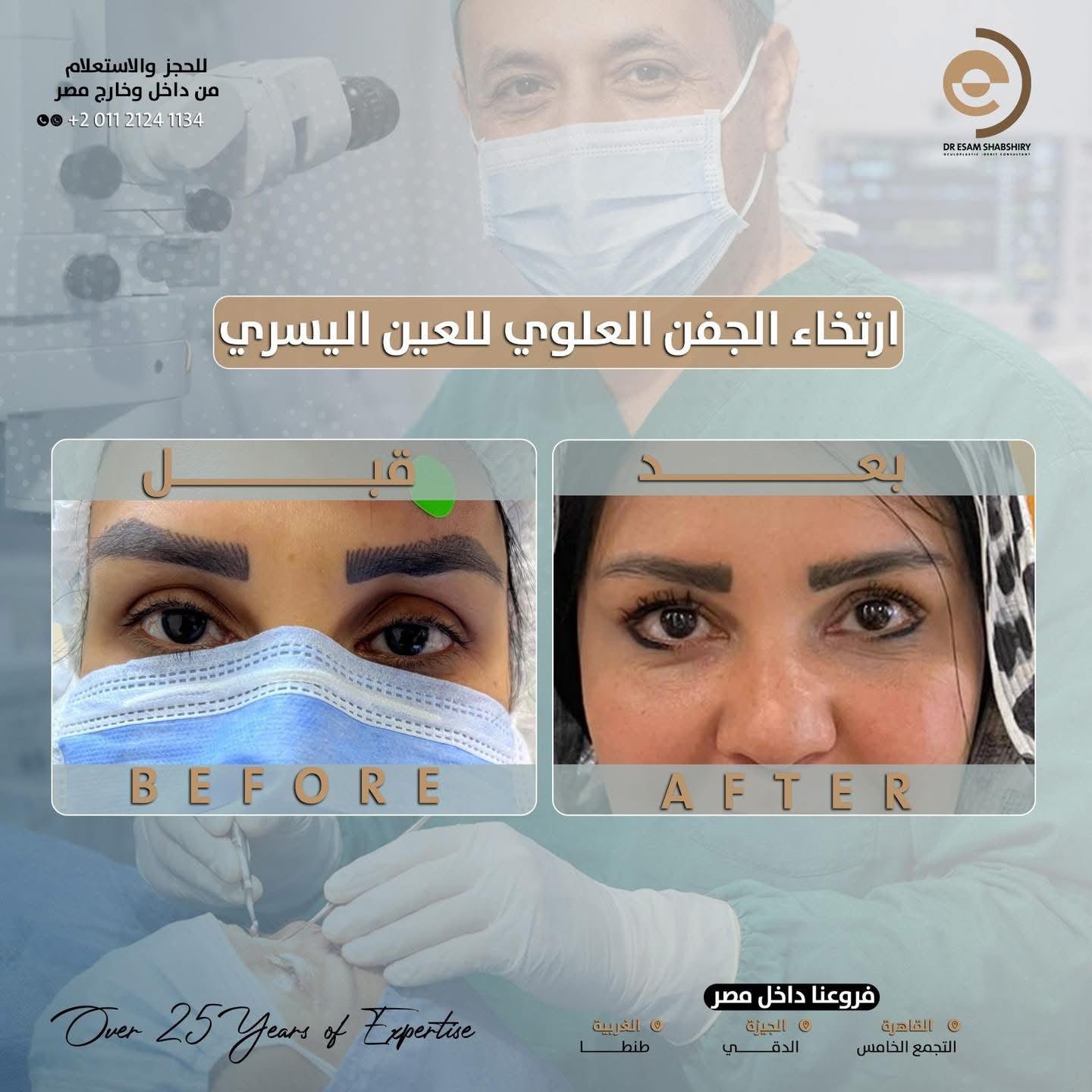 رفع الجفن العلوي وكشف بؤبؤ العين ومجال الرؤية