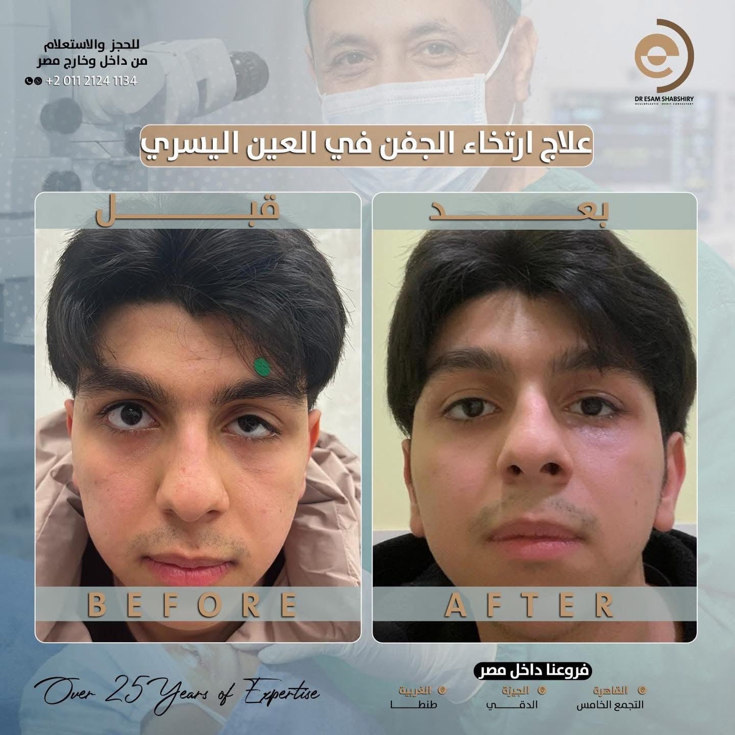 إصلاح ارتخاء الجفون المزمن بدقة ميكروسكوبية