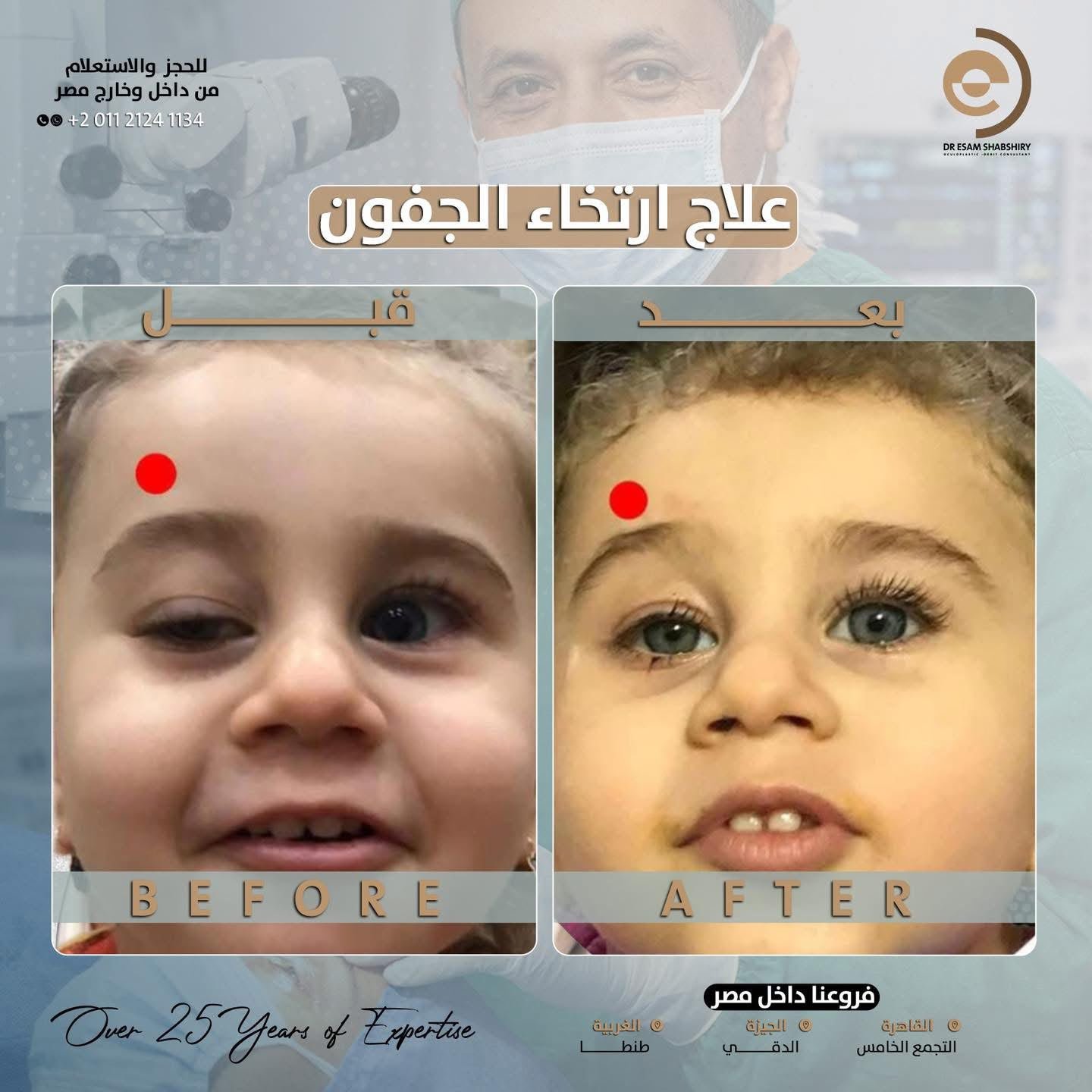 تماثل كامل في ارتفاع فتحتي العينين بعد الجراحة