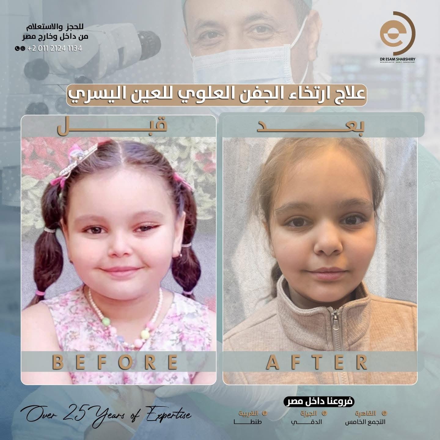 تثبيت العضلة الرافعة بدون التأثير على حركة العين