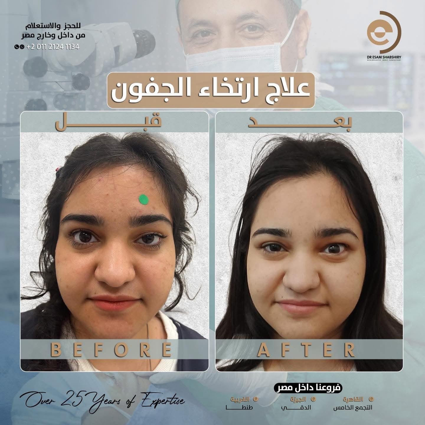 تصحيح هبوط الجفن بعد جراحات سابقة