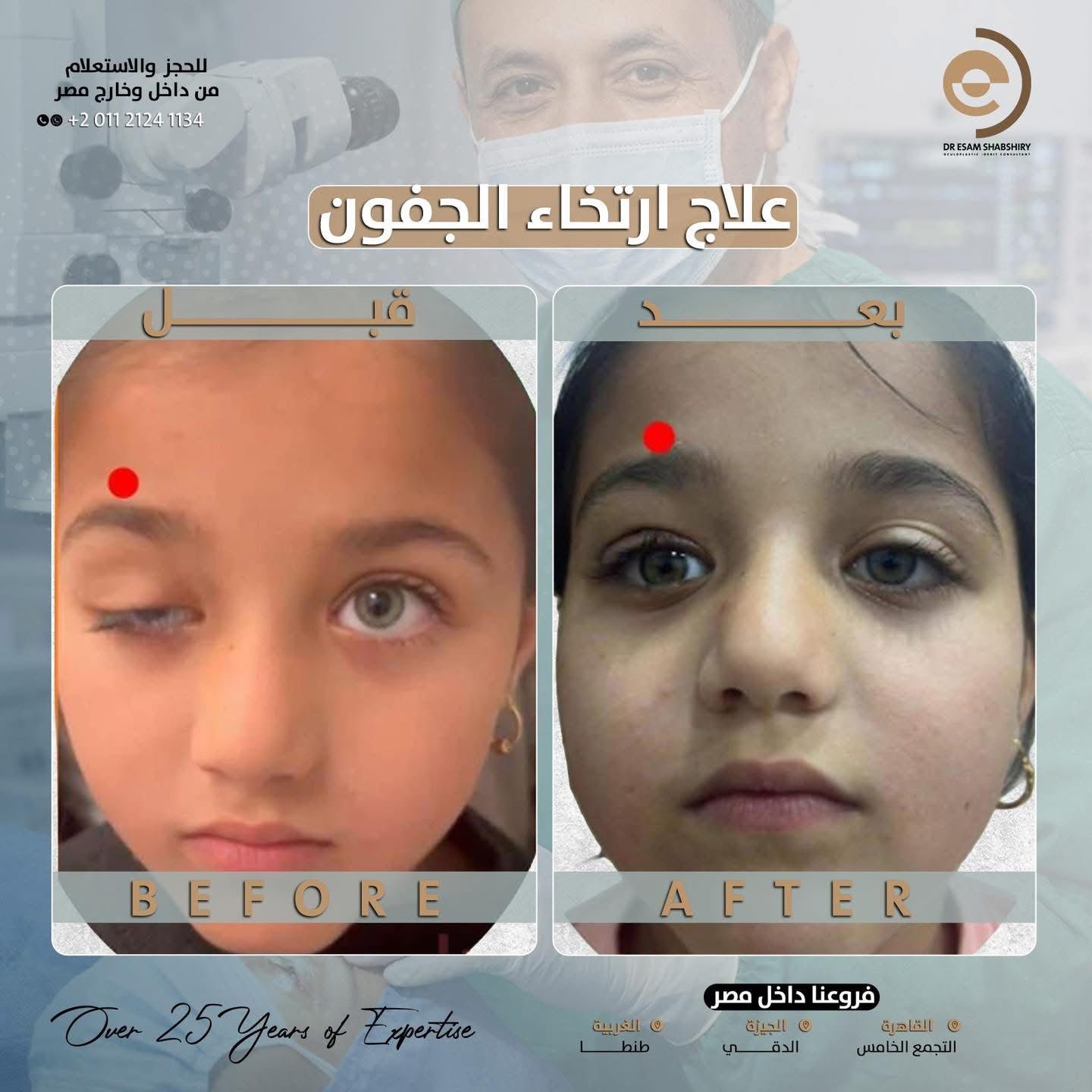 استعادة التناسق البصري والجمالي للجفنين